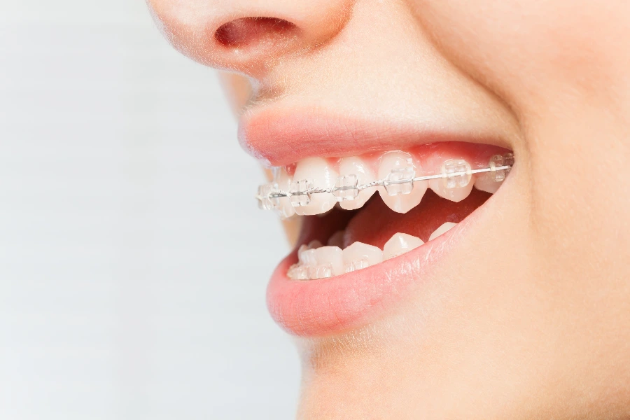Clear ceramic braces for discreet orthodontic treatment